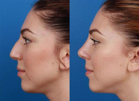 Facial Plastic Surgeon | Rhinoplasty Nose Jobs New York | NYC Dr. Miller