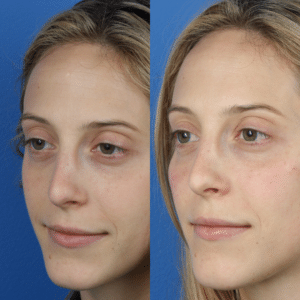 liquid facelift results in New York City, NY