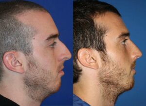 3-D Rhinoplasty results in NYC