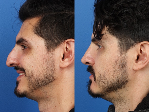 rhinoplasty results in NY, NY