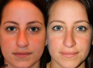 rhinoplasty results in NYC for common nose shape, roman nose