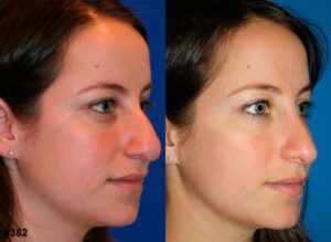 before and after image of rhinoplasty for snub shaped nose in NYC