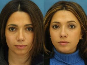 rhinoplasty results from best facial plastic surgeon in NYC