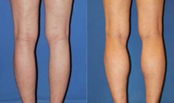 Calf implants to add shape to the lower legs of a female patient by Dr. Miller. After surgery, calves are larger and more shapely.