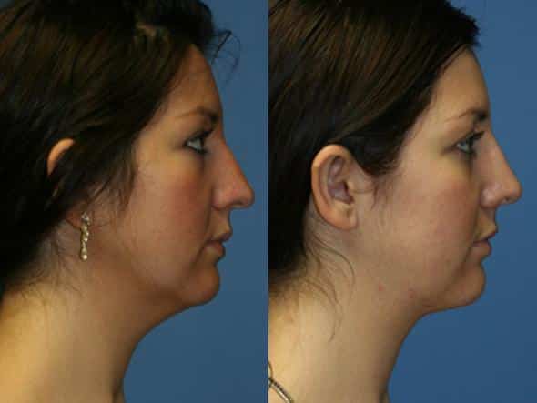 neck liposuction in new york before and after