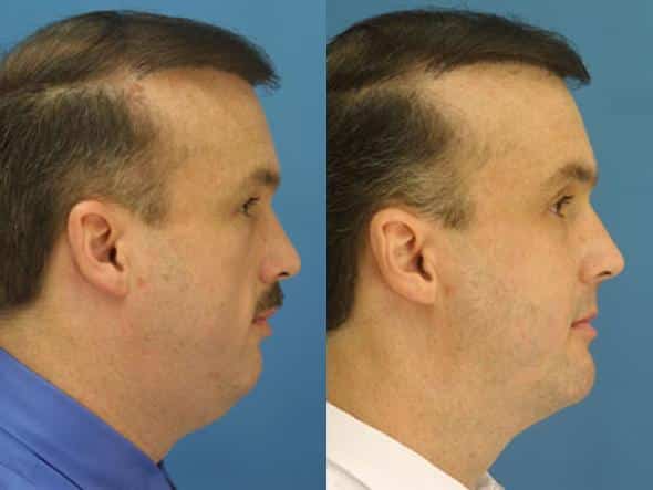 neck lipo on a male patient in nyc