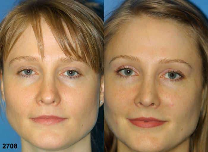 pinched nose tip correction before and after