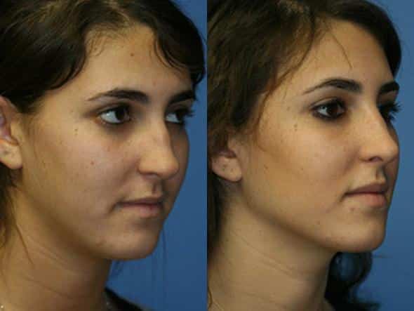 Side shot of a young woman before and after her rhinoplasty, NYC, NY.