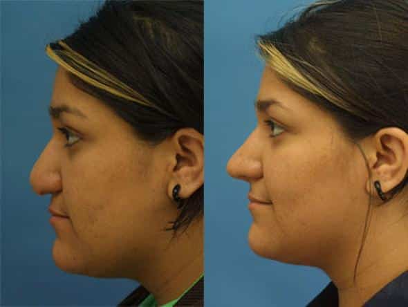 tip drop revision rhinoplasty on a female patient in new york