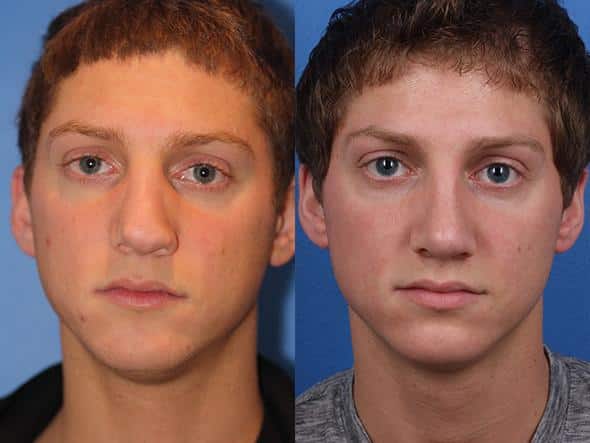 Image comparing the face of a male patient before and after he had a rhinoplasty. The procedure has contoured the nose giving a nicely toned appearance