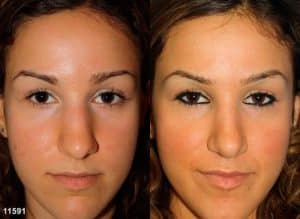 revision rhinoplasty after a bad nose job in new york