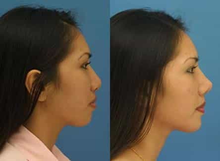 NYC Asian Nose Job Surgeon