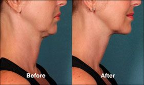 Kybella Fat Reduction New York