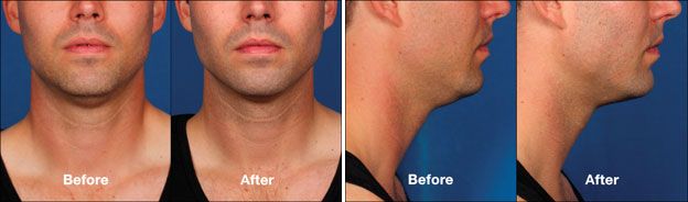 Kybella Chin Reduction Procedure