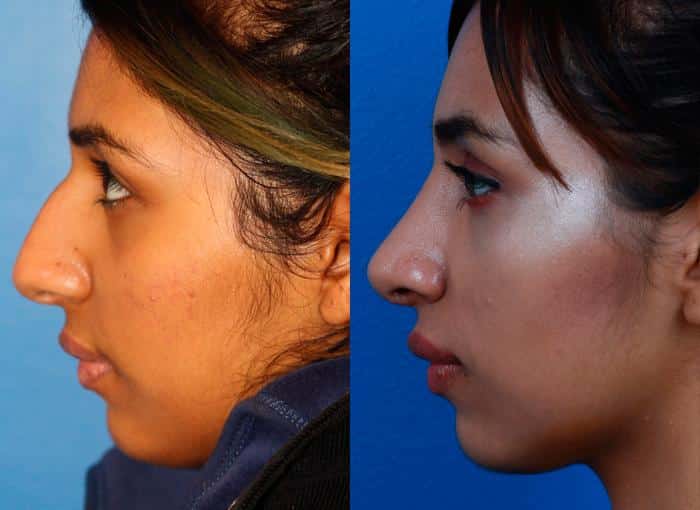 New York Plastic Surgeon Indian Nose Job