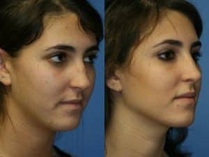 New York Rhinoplasty Correction
