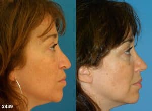 Image showing sides-shots before and after a woman got her nose corrected after a nose job, also known as rhinoplasty, New York, NY