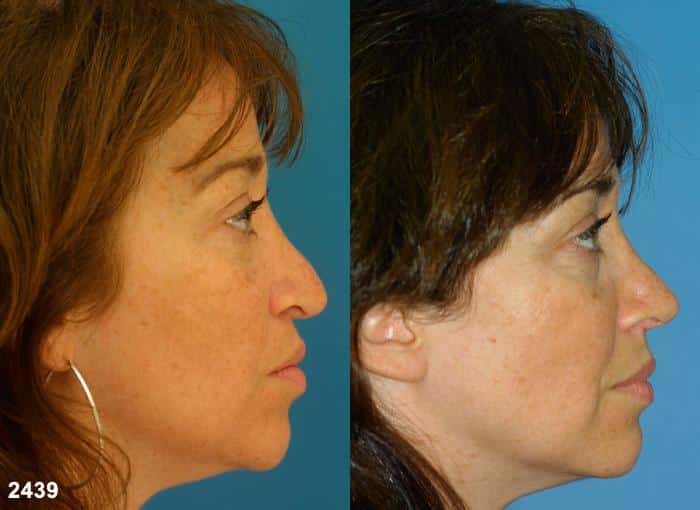 NYC Nose Job Correction after a tip drop