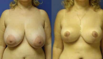 NYC Boob Reduction Procedure