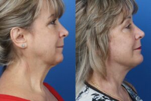 facelift and necklift surgery results to remove turkey neck from a patient in NYC, NY