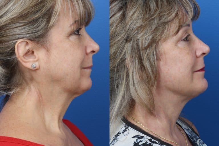 Cosmetic Procedures For Getting Rid Of Turkey Neck Philip Miller Md