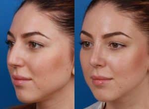 Rhinoplasty before and after new york