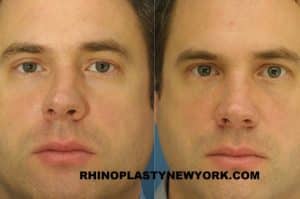 broken nose treatment nyc