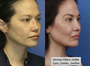 Injectable nose job results from liquid nose job expert in Manhattan, NY