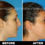 before and after of a woman after a rhinoplasty procedure in new york
