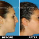 before and after of a woman after a rhinoplasty procedure in new york