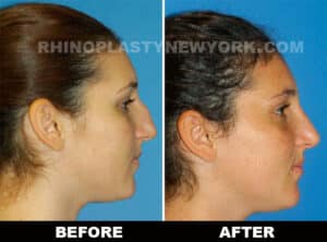 microrhinoplasty before after photo