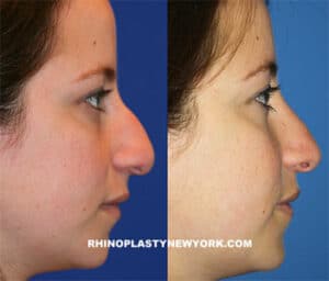 before after nose reduction nyc