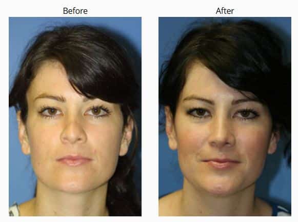 Before and After photos of a woman that had a revision rhinoplasty, New York, NY