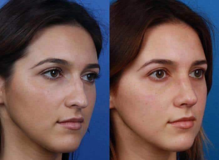 Best Rhinoplasty and Nose Jobs in New York City, NY Dr. Philip Miller