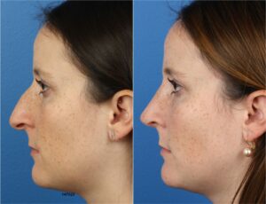 rhinoplasty before and after results on a female patient