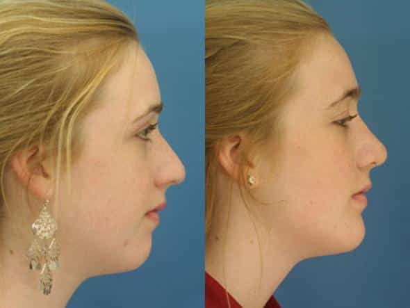 chin implant new york