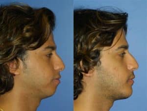 Before and After images of a male patient with an improved jawline after the procedure