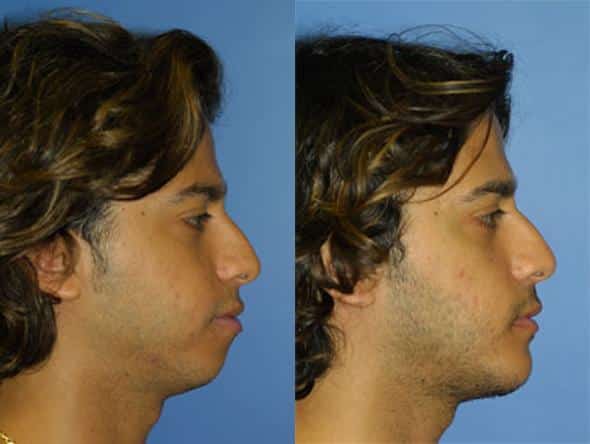 chin implant before and after