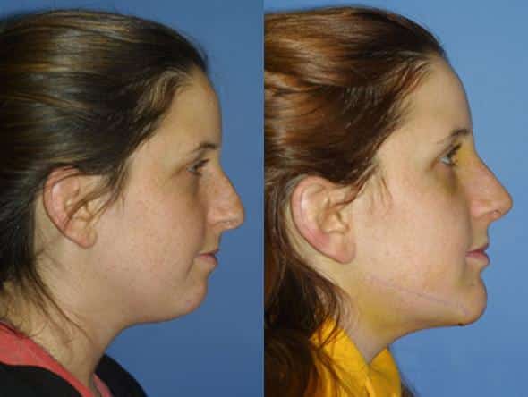 silicone chin implant before and after