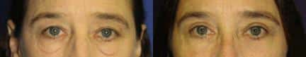 Blepharoplasty to reduce hooding above the eye and bags below on a female patient by Dr. Miller. After treatment, patient's eyes look more open and awake, while area under the eyes is smoother.