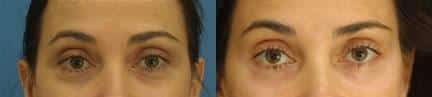 Blepharoplasty to reduce hooding above the eye and bags below on a female patient by Dr. Miller. Surgery opens eyes and reduces bags and dark circles under the eyes.