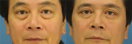 Blepharoplasty to raise upper lid and reduce bags under the eyes of a male patient by Dr. Miller. After surgery, patient's eyes look more open and bags underneath are significantly reduced.