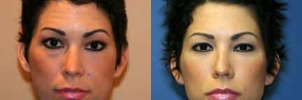 Lower blepharoplasty to remove discoloration and bags under the eyes of a female patient by Dr. Miller. Surgery creates smoother contour under the eyes while reducing the dark circles and puffiness that resulted in a weary appearance.