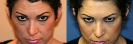 Lower blepharoplasty to remove discoloration and bags under the eyes of a female patient by Dr. Miller. Photo shows smoother, clearer appearance under the eyes after surgery.