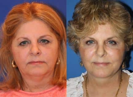Blepharoplasty to lift the upper lid and reduce bags and discoloration under the eyes of a female patient by Dr. Miller. After surgery, patient's eye look more awake and refreshed.