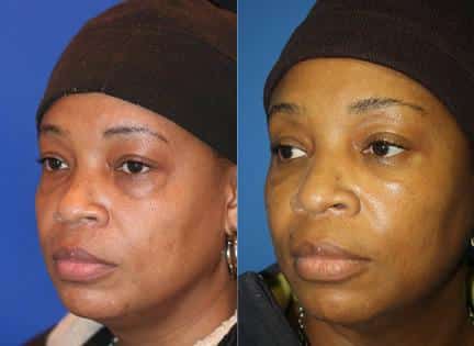 Lower blepharoplasty to remove discoloration and bags under the eyes of a female patient by Dr. Miller. Surgery creates smoother skin under the eyes with a refreshed appearance.