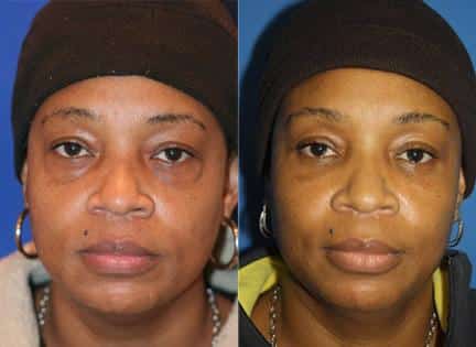 Lower blepharoplasty to remove discoloration and bags under the eyes of a female patient by Dr. Miller. Surgery smooths area under the eyes for a refreshed appearance.