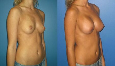 patient-10956-breast-augmentation-before-after-1