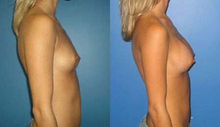 patient-10956-breast-augmentation-before-after-2