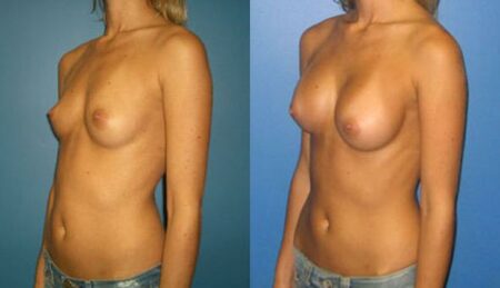 patient-10956-breast-augmentation-before-after-3